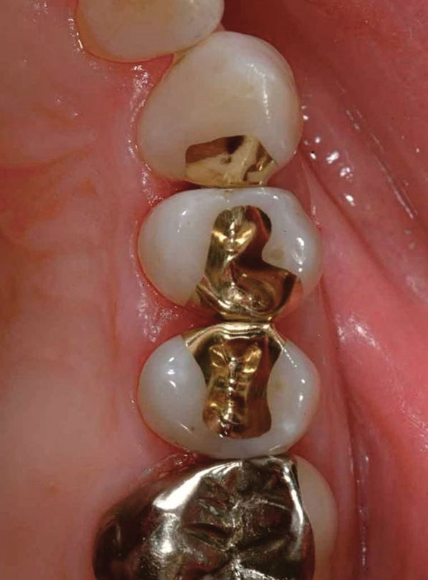 Conservative Cast Gold Inlays August 2020 Inside Dentistry