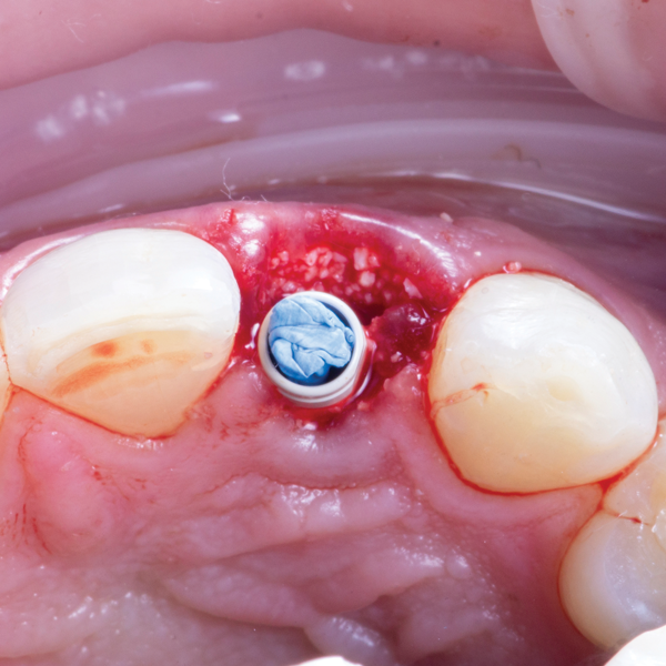 January Dawn of a New Day CE Novel Bleaching Tray Fabrication