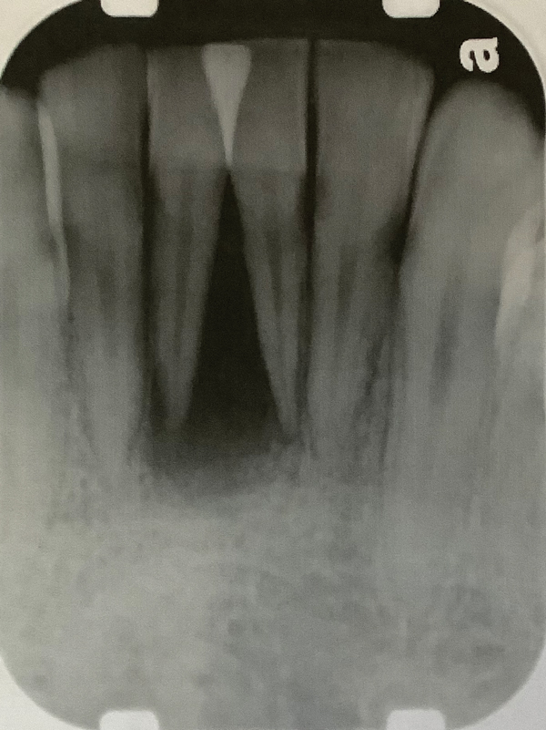 Periodontal Regeneration Therapy for Compromised Anterior Teeth