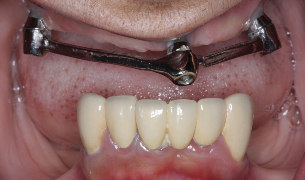 FullMouth Rehabilitation With Fixed, ImplantSupported Prostheses