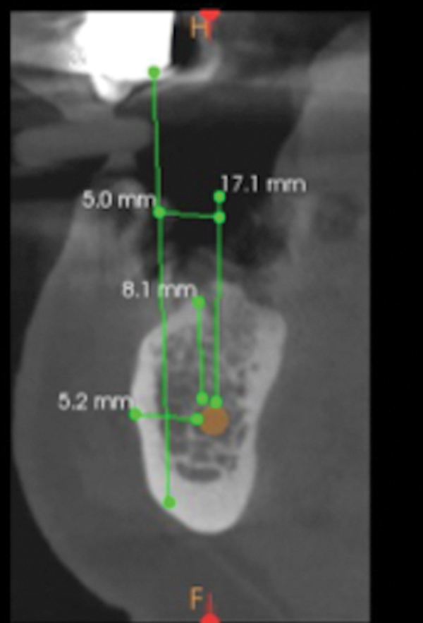 Implant Placement Lateral to the Inferior Alveolar Nerve Selective
