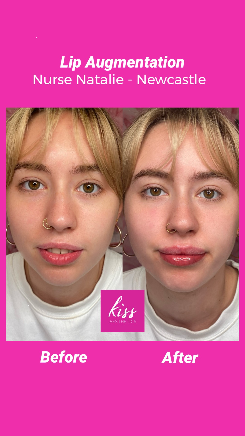 Sunderland Kiss Aesthetics