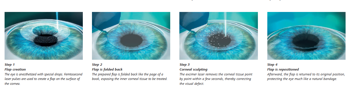 Types of Eye Laser Surgery Adelaide Eye & Laser Centre