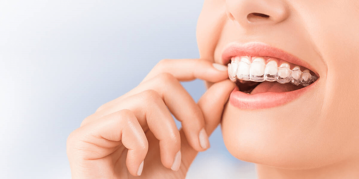 Traditional Braces Vs Invisalign Afflux Dentistry