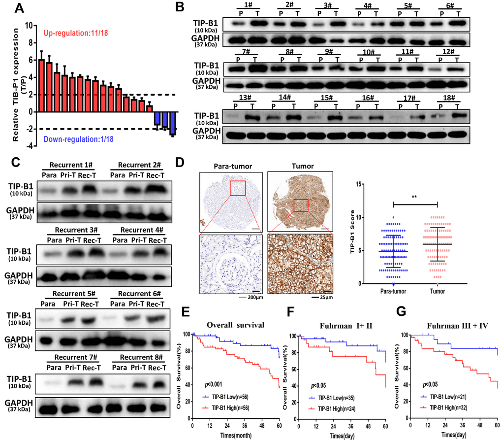 TIPB1 promotes kidney clear cell carcinoma growth and metastasis via