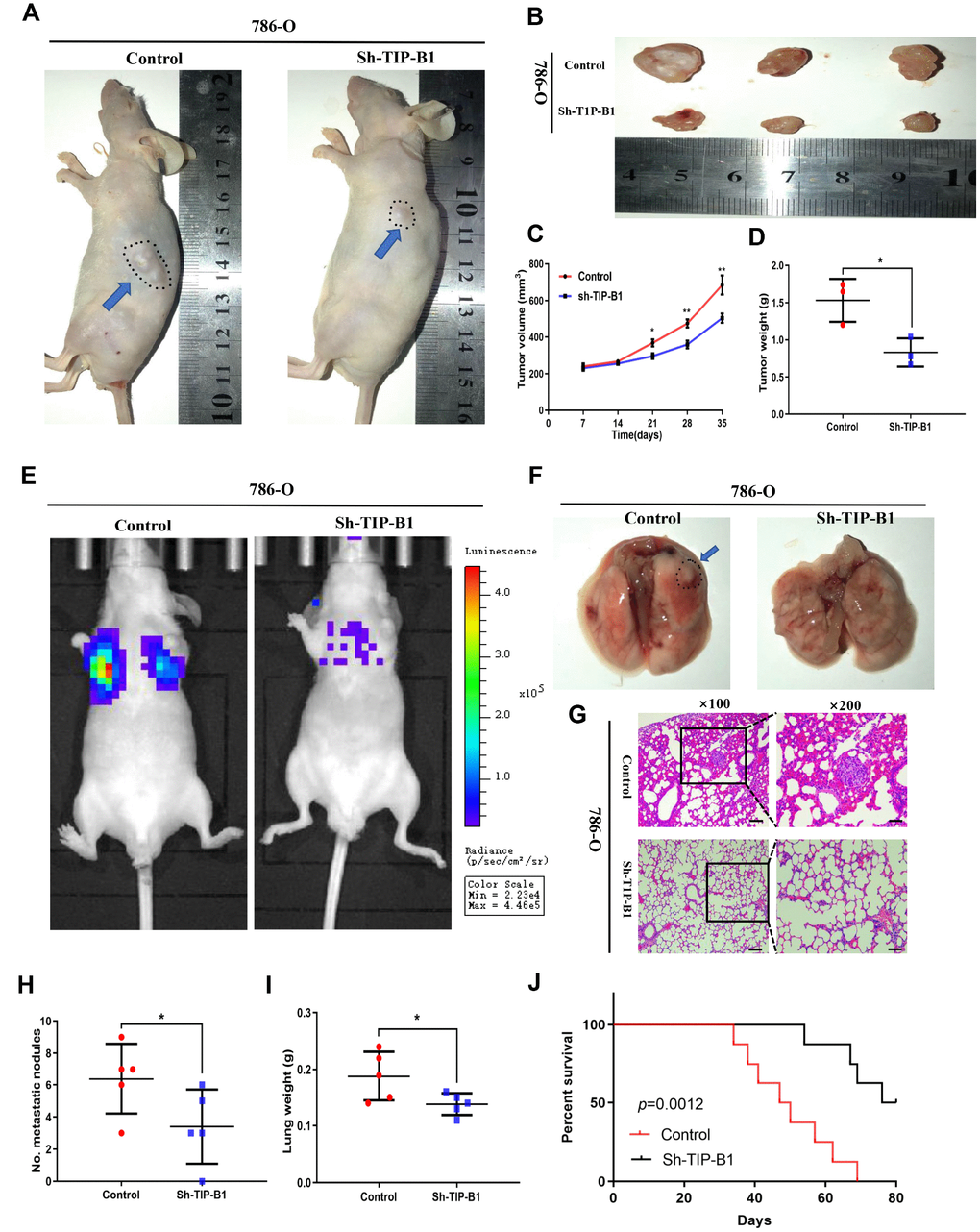 TIPB1 promotes kidney clear cell carcinoma growth and metastasis via
