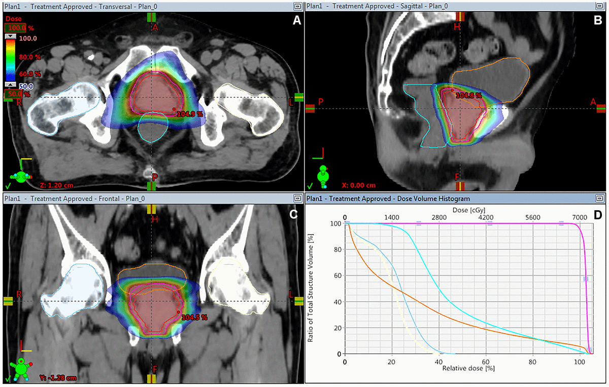 Hypofractionated versus conventionally fractionated imageguided