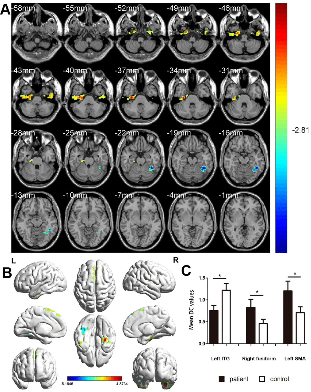 Altered brain network centrality in patients with mild cognitive
