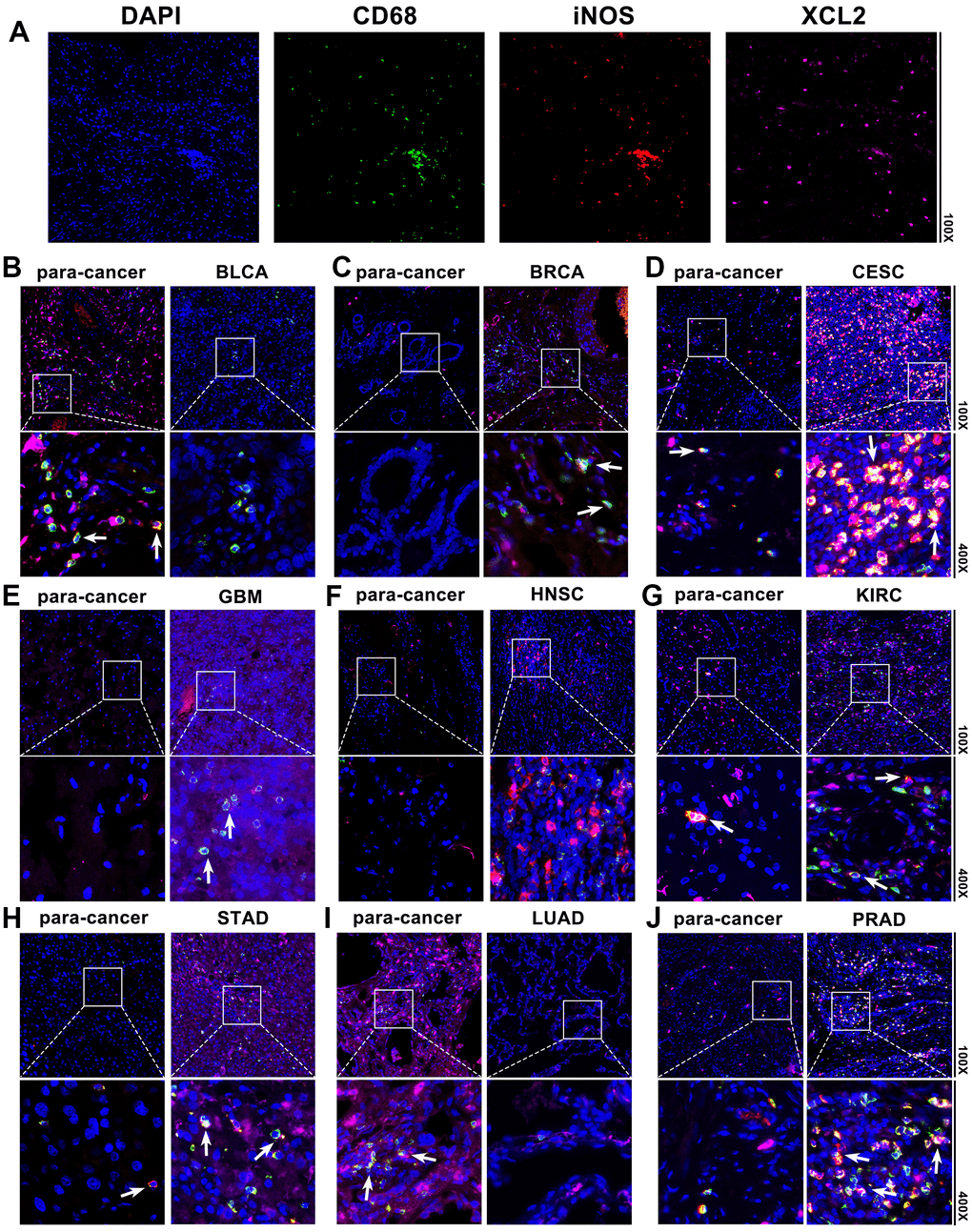 Comprehensive analysis reveals XCL2 as a cancer prognosis and immune