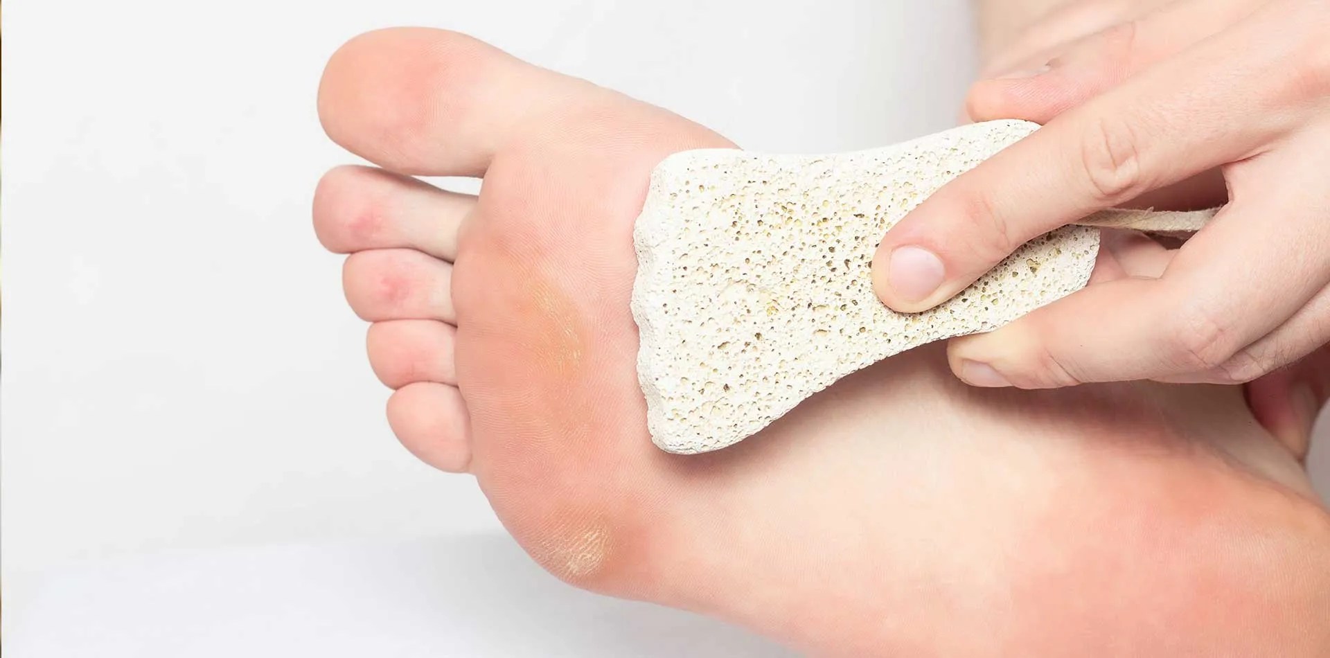 Painful Callus On Heel Of Foot Treatment Flash Sales