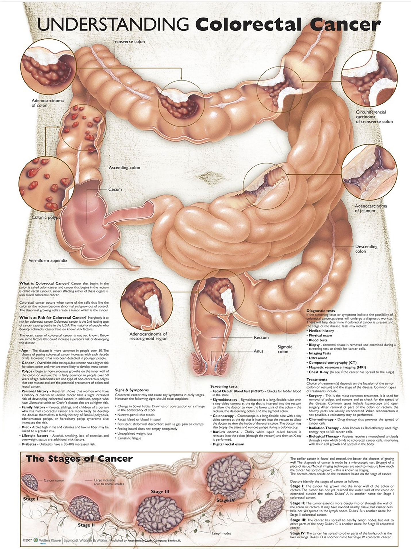 Losing Weight Can Help Reduce the Risk of Colorectal