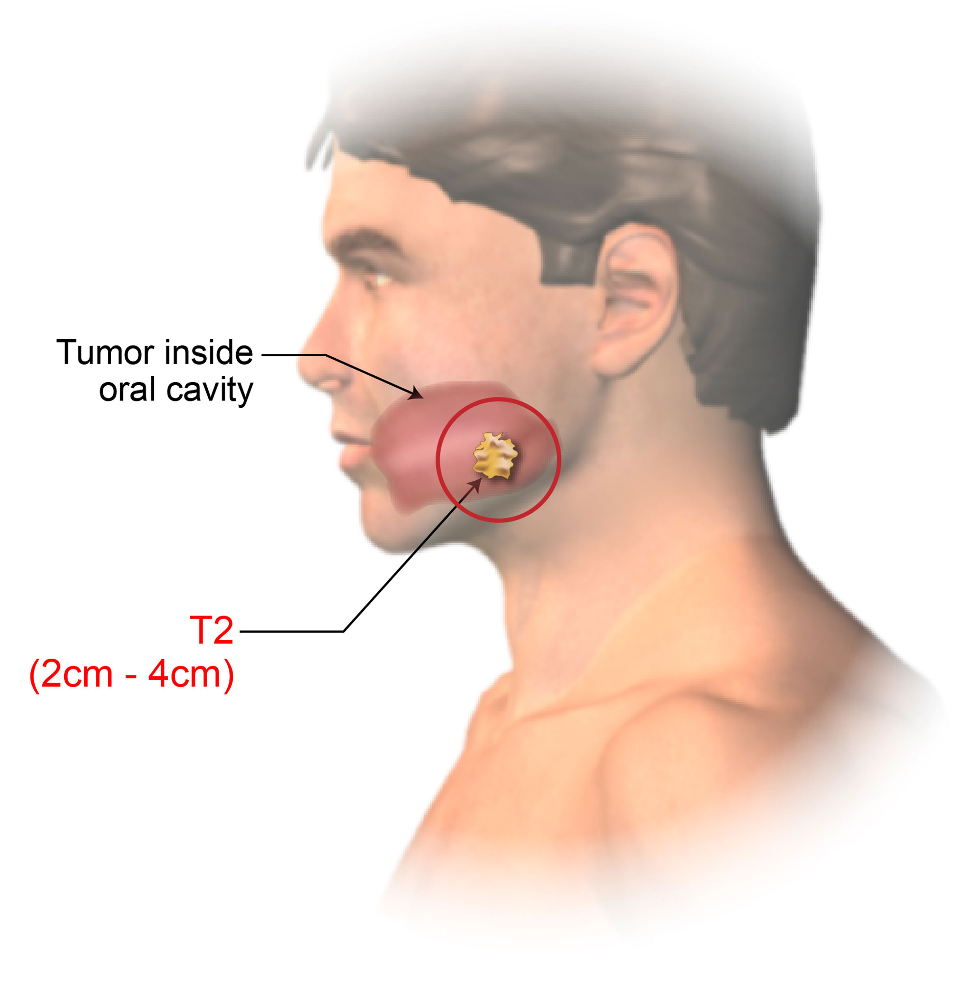 Staging Of Lip And Oral Cavity Cancer American Head Neck