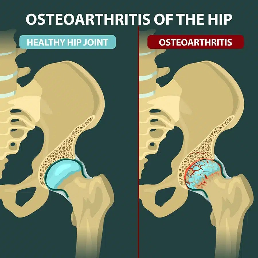 Understanding and Managing Hip Osteoarthritis Finding Relief Through Physiotherapy ADVANZ HEALTH
