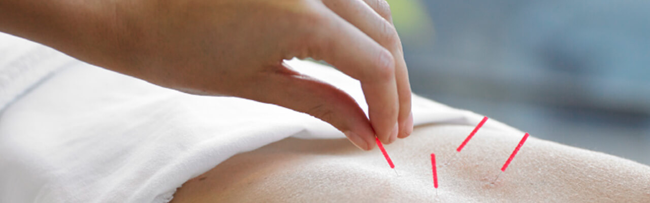 How to Prepare for an Acupuncture Appointment AIAM Wellness Center
