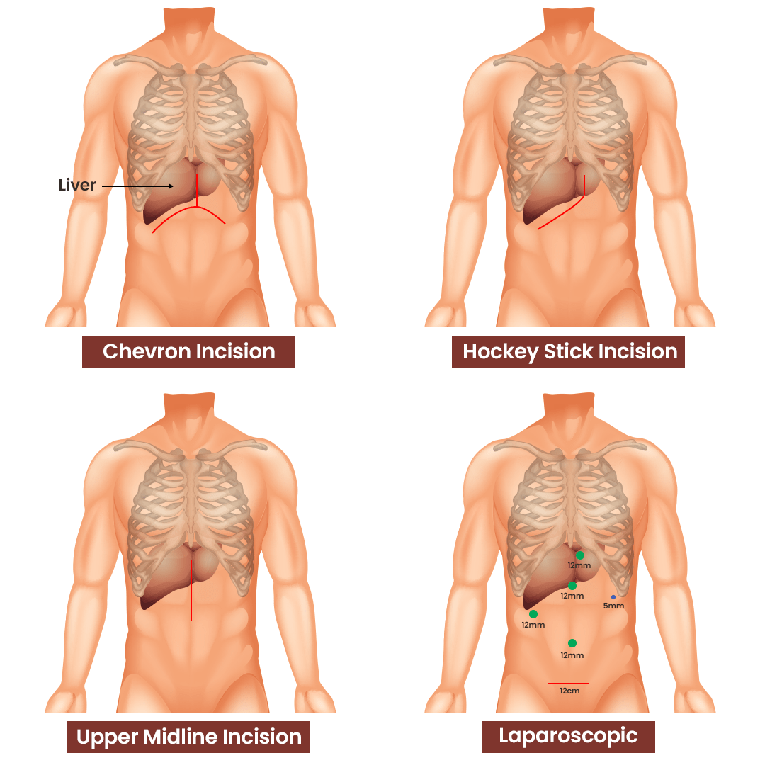 Liver Laparoscopic Surgery Hospital in Delhi NCR AILBS