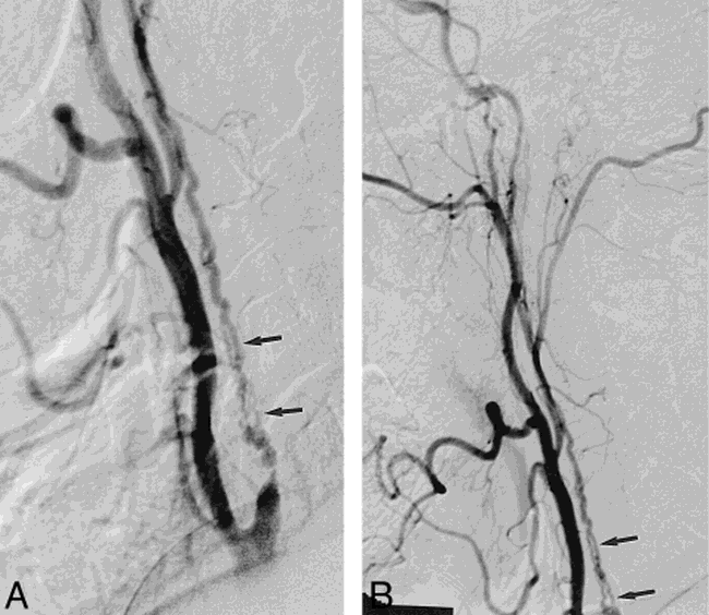 Vasa Vasorum Another Cause of the Carotid String Sign American