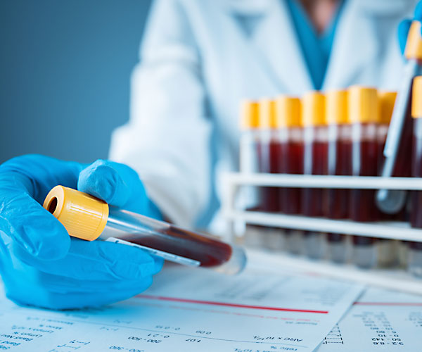 Drug Screening Akeso Occupational Health