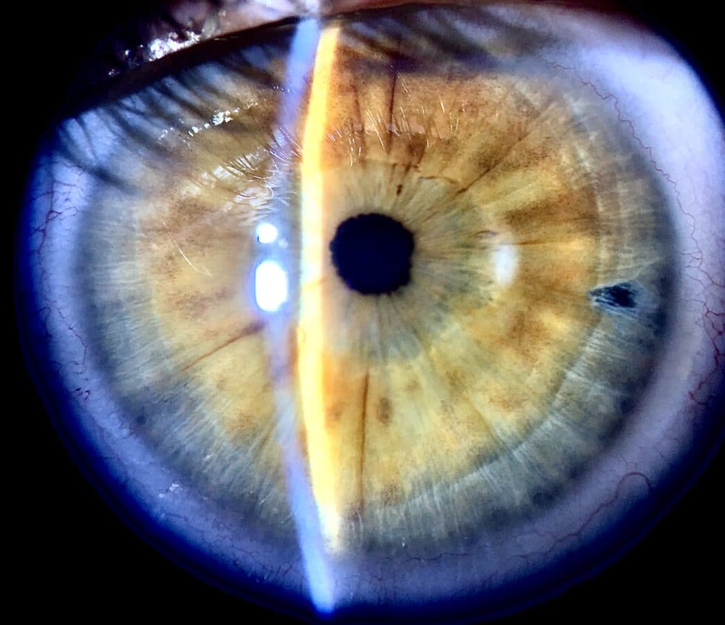 Laser Iridotomy at Christine Garrett blog