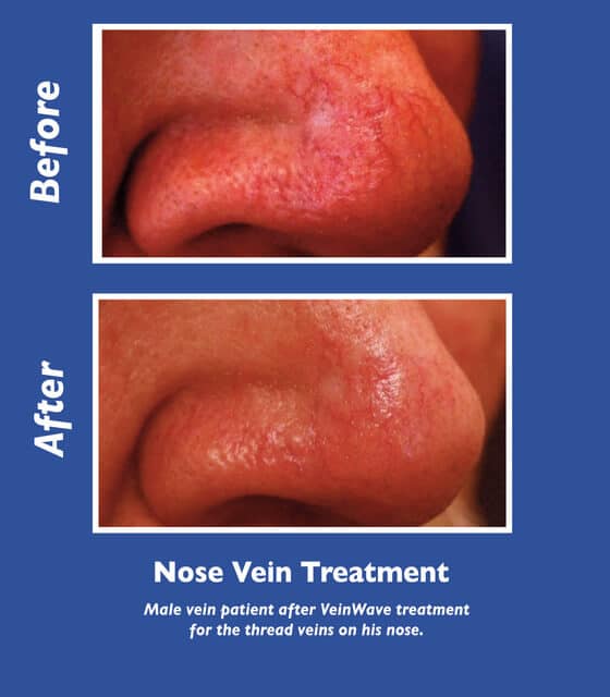 Facial and Nose Veins Albuquerque Vein & Laser Institute