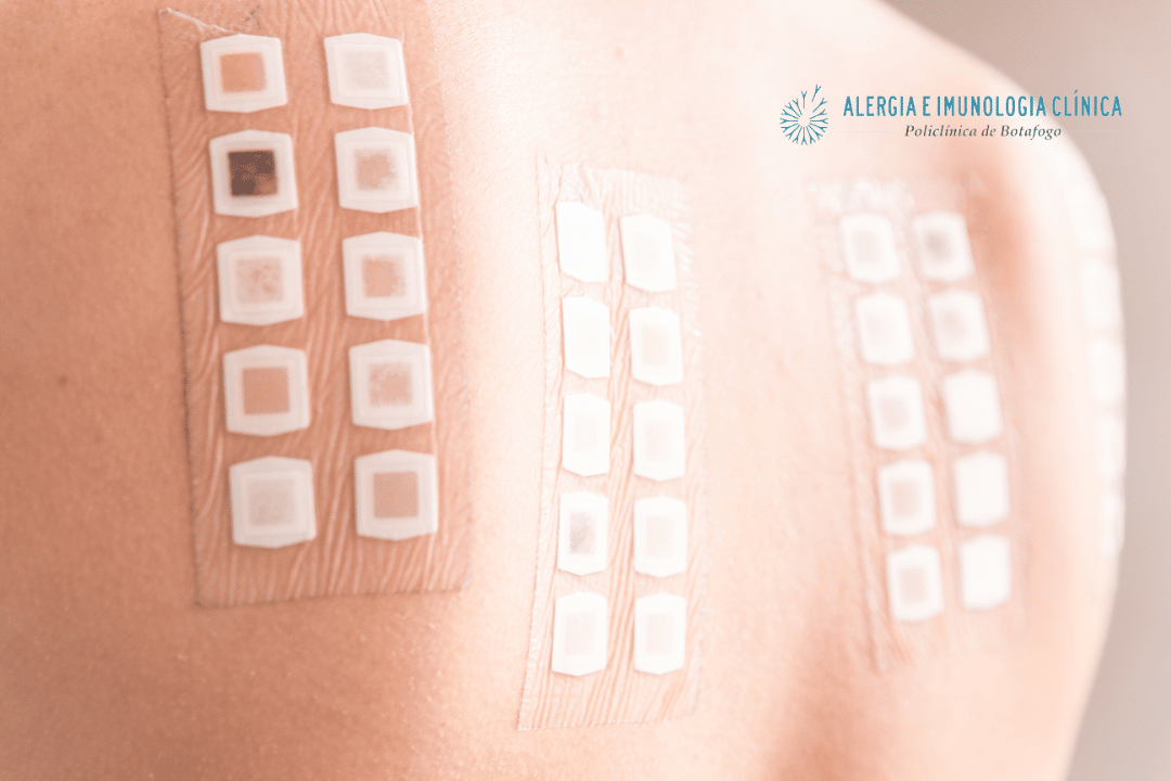 Teste de contato ou patch test. Saiba como é feito e quais os tipos