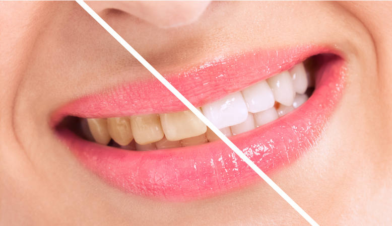 Benefit from Professional Teeth Whitening in Columbia