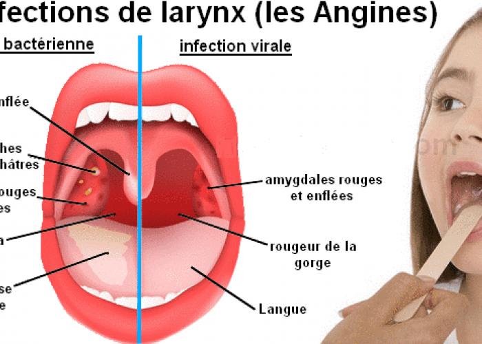 Angine distinguez le vrai du faux ! Algérie1