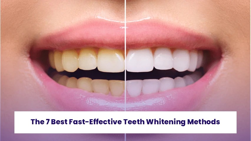 The 7 Best Fast Effective Teeth Whitening Methods Aliadent