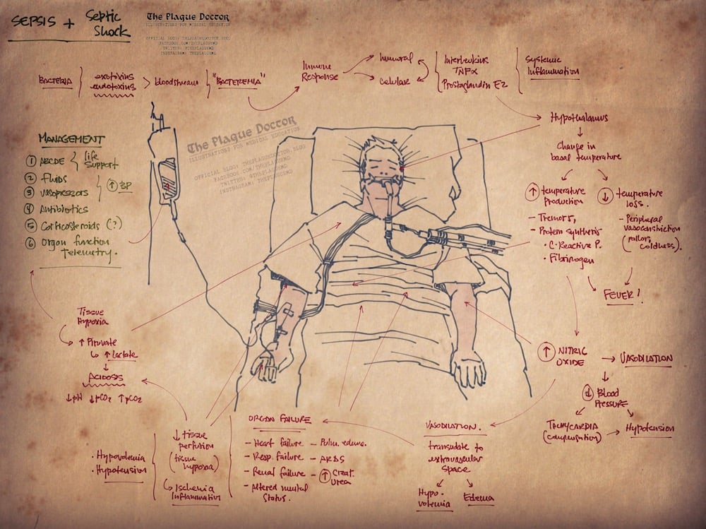 Infographic Sepsis And Septic Shock