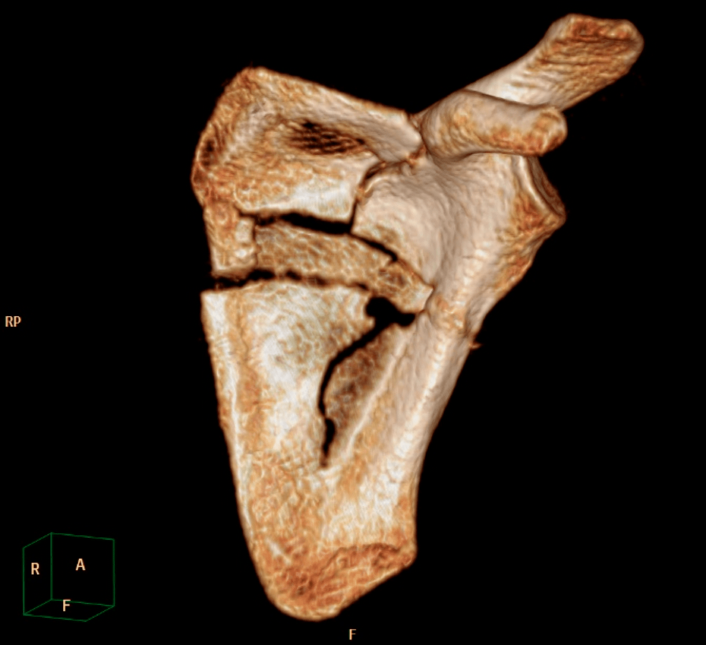Scapula Fracture