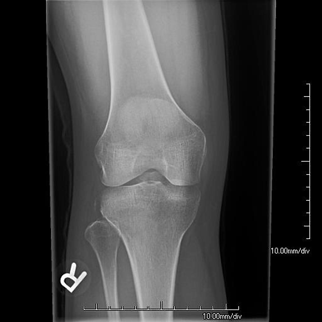Tibial spine avulsion fracture ALiEM