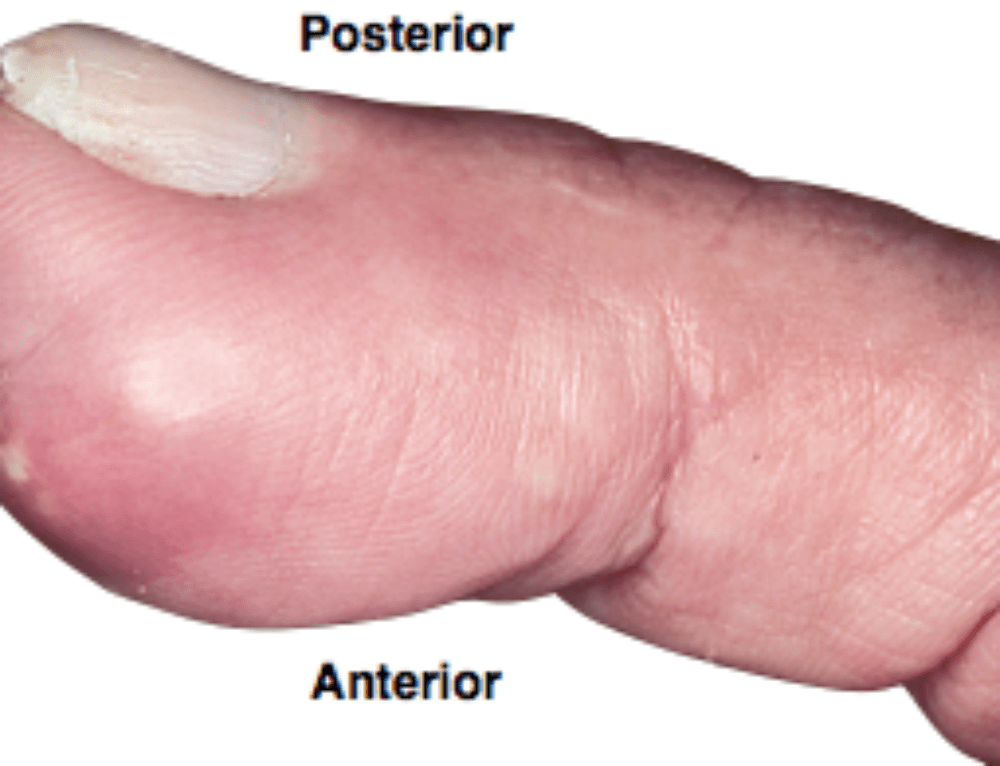 Ultrasound for Verification of Endotracheal Tube Location
