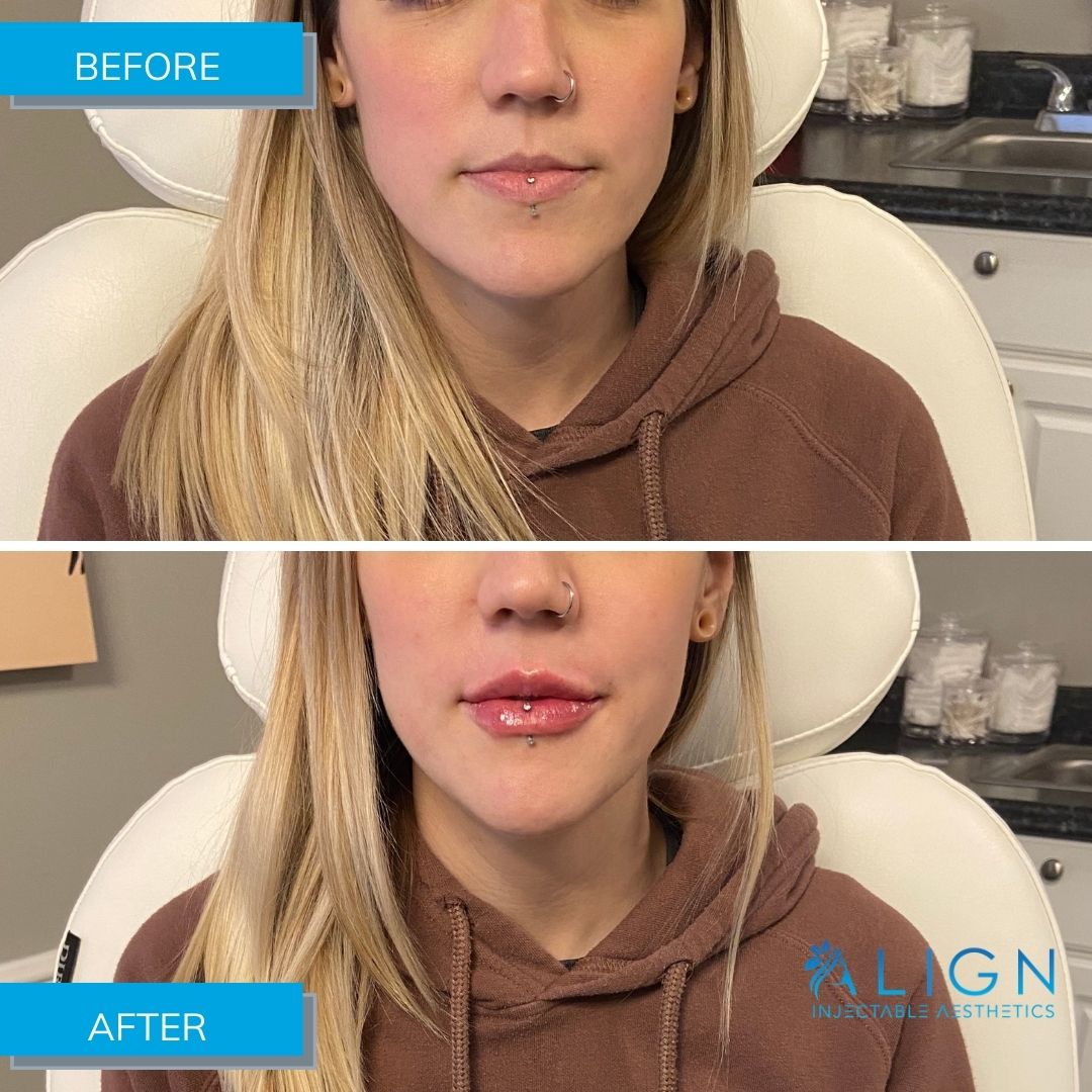 Before and After Lip Injections at Align Injectable Aesthetics