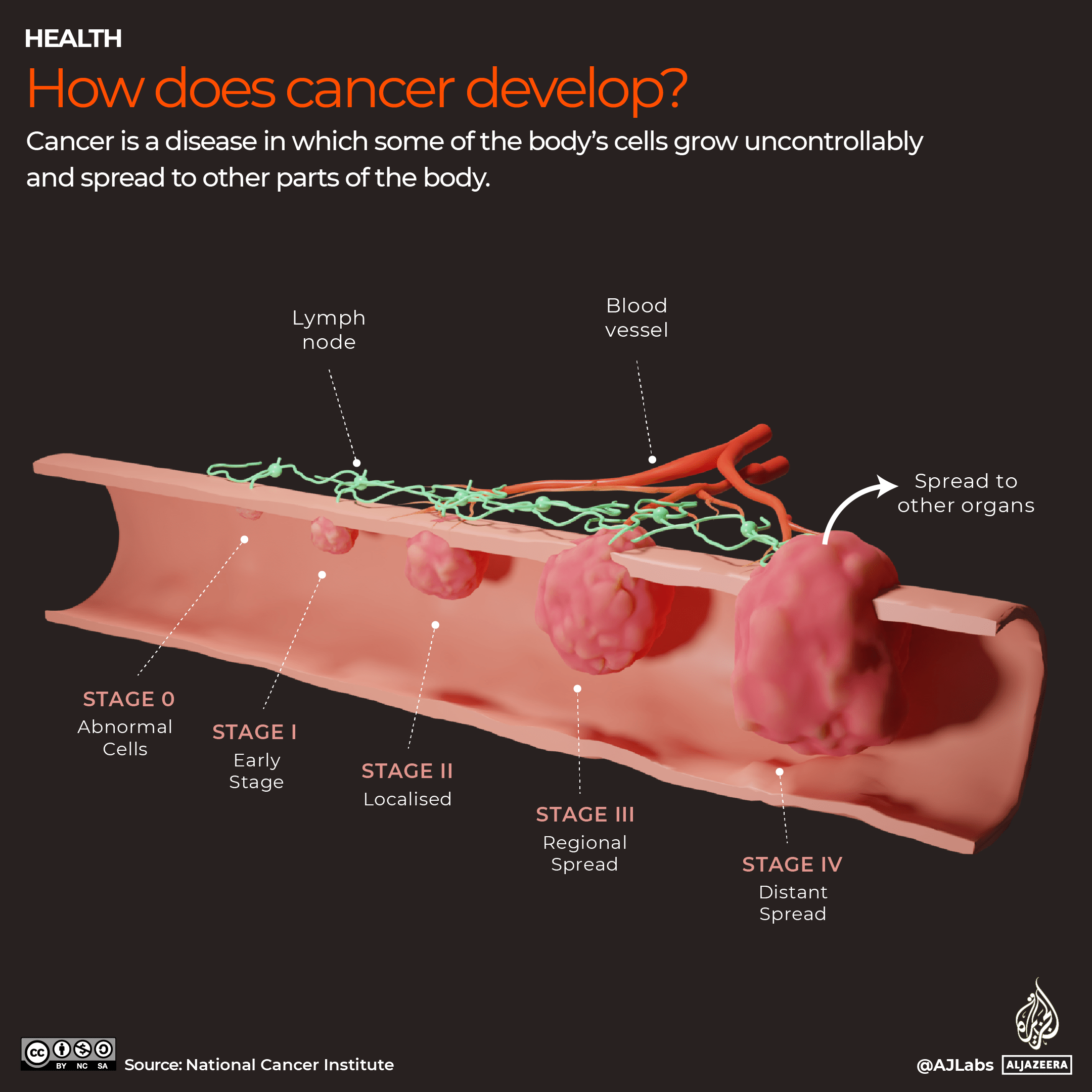 Infographic A global look at cancer
