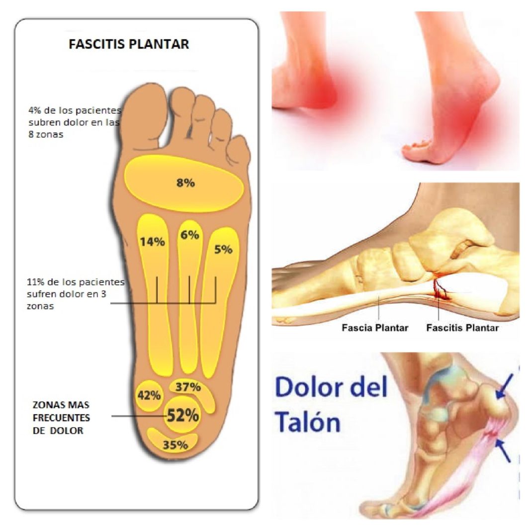 lesiones en el padel fascitis plantar