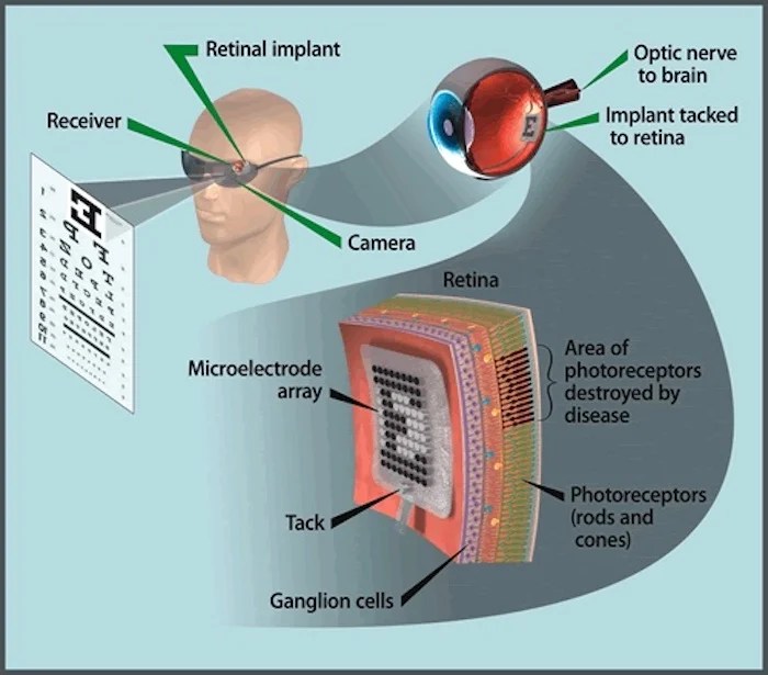 The Future of Vision Looks Bright With Advances in Prosthetic Retinas