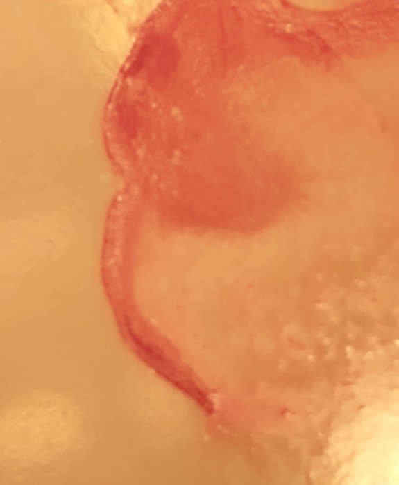 Red Wormlike Organisms Pulled from Woman's Nose Medical Consultation