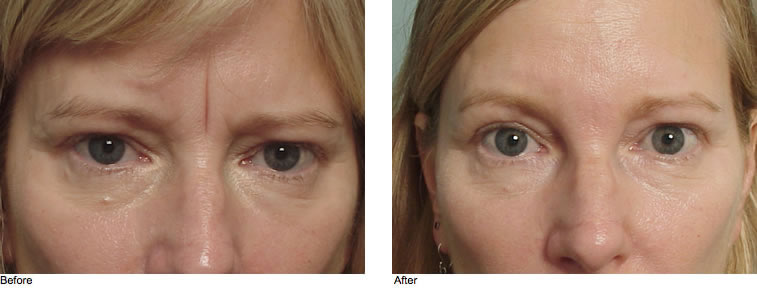 Botox® & Dysport® Allcroft Plastic Surgery