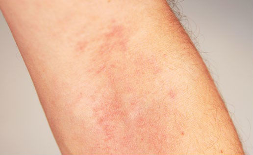 Allergie und Anaphylaxie Anzeichen allergie.de