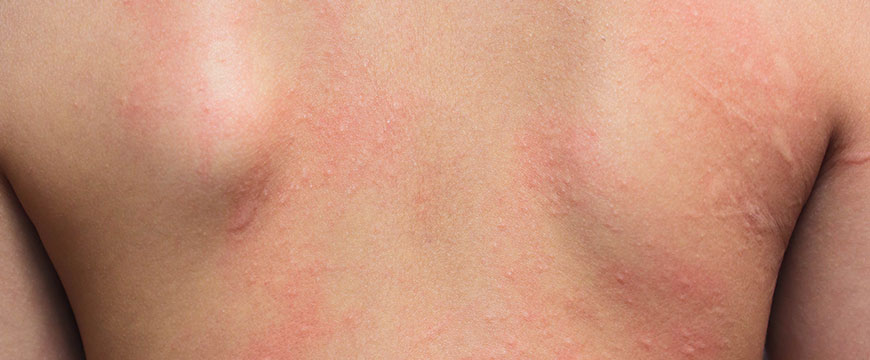 Home Remedies to Relieve Hives and Skin Allergy During Pregnancy Allergy