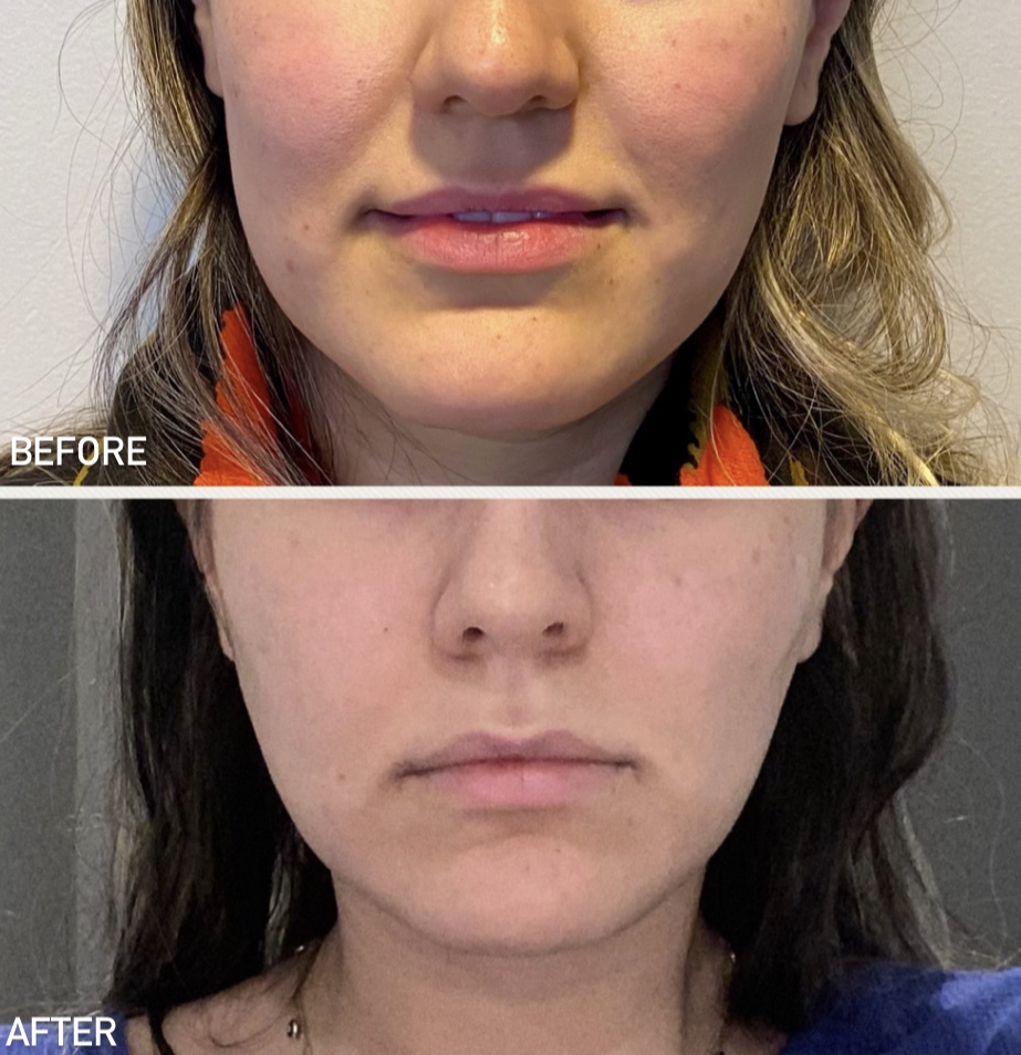 PDO Thread Lift Los Angeles, Brentwood Allergy & Skin Spa