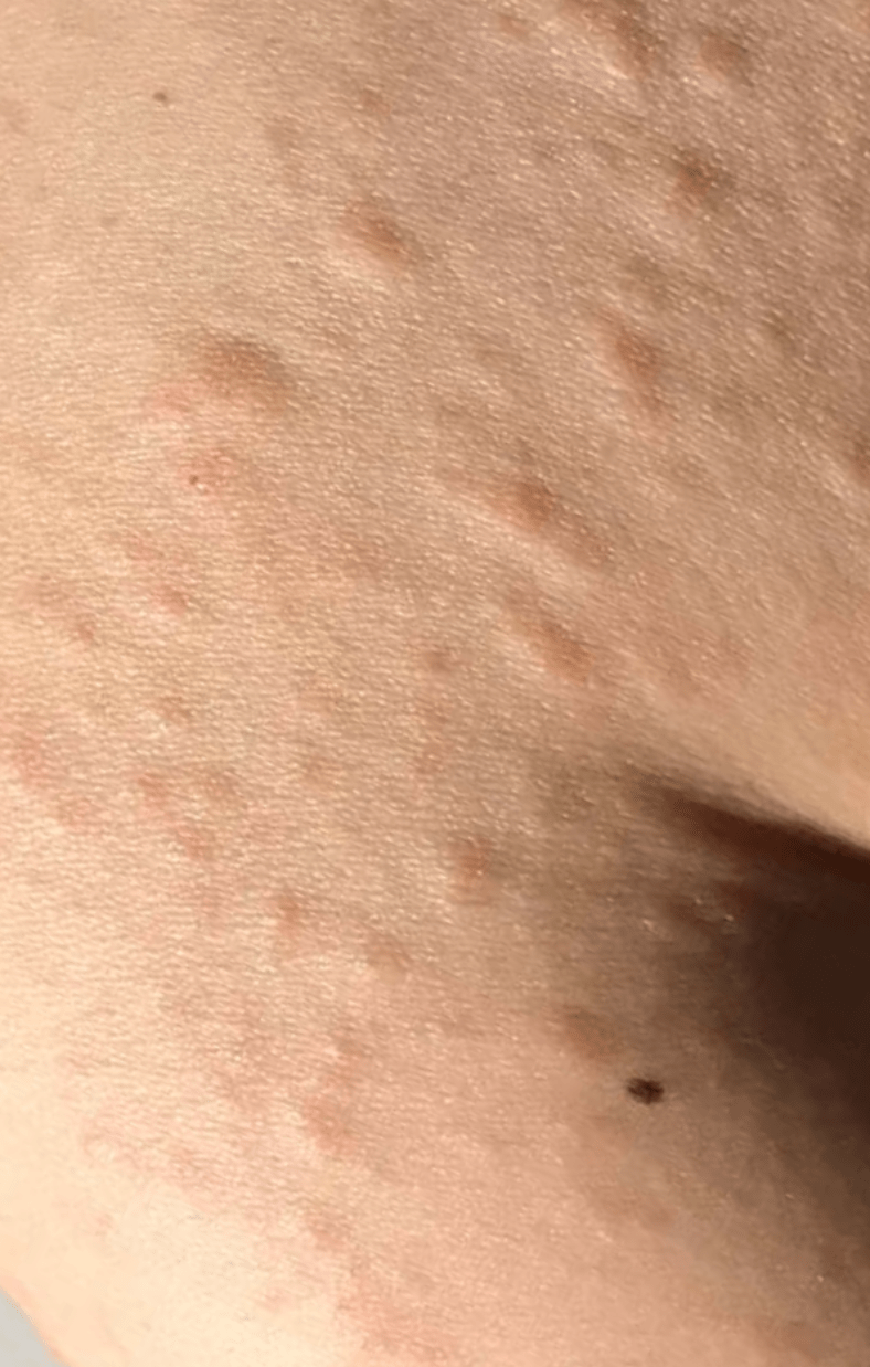 Chronic Spontaneous Urticaria Leaflet Allergy UK National Charity