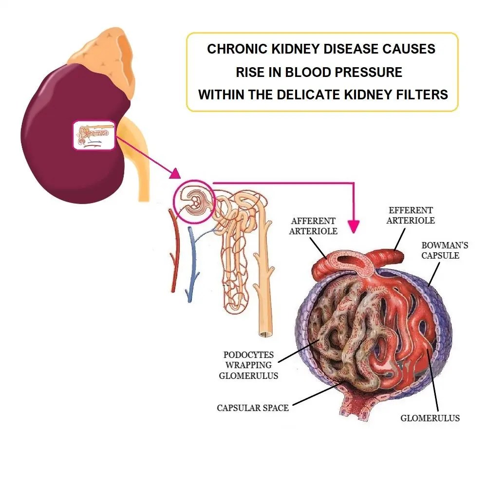 High Blood Pressure in CKD All Things Kidney Official