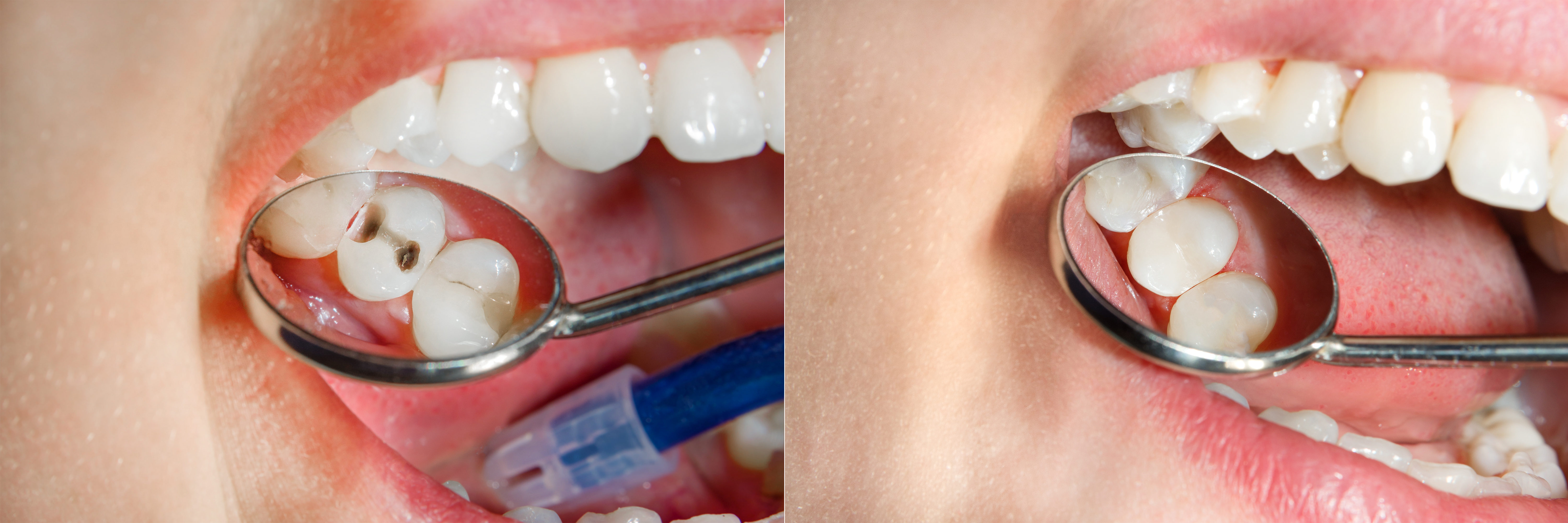 ToothColored Dental Fillings Advantages Alon Dental Care