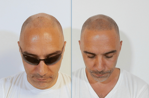 Haartransplantation Forum Alternativen / Ergänzungen (z.B