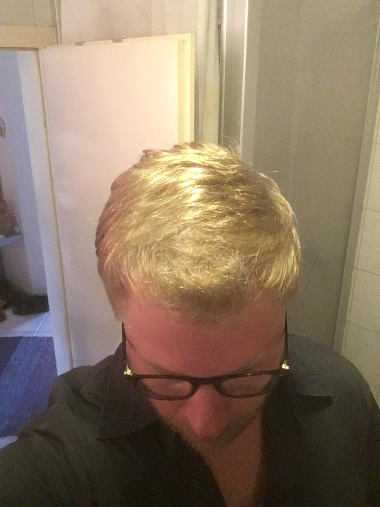 Haartransplantation Forum Hairmedic » Hairmedic Deutschland 2000