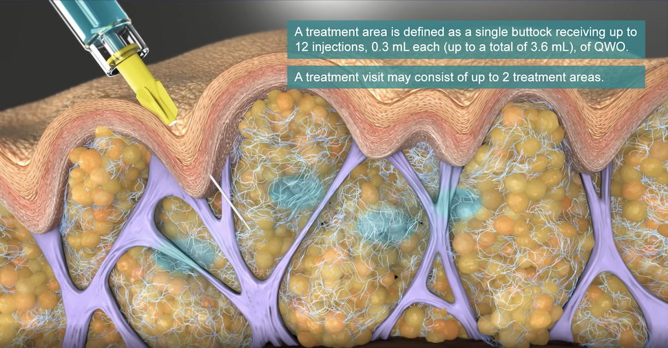 Answering Your Every Q on Qwo Spring 2021’s Cellulite Rx Tx