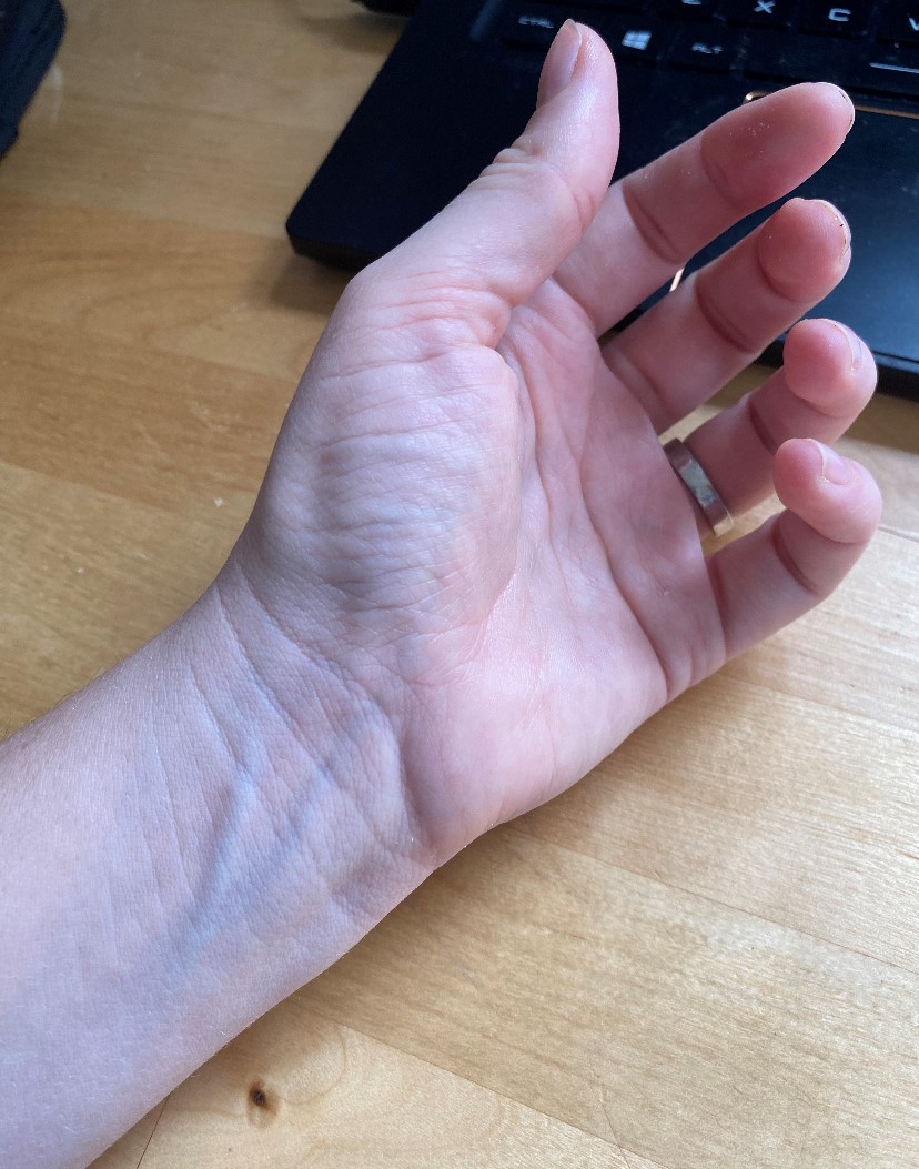 Thumb Atrophy ALS Support Community