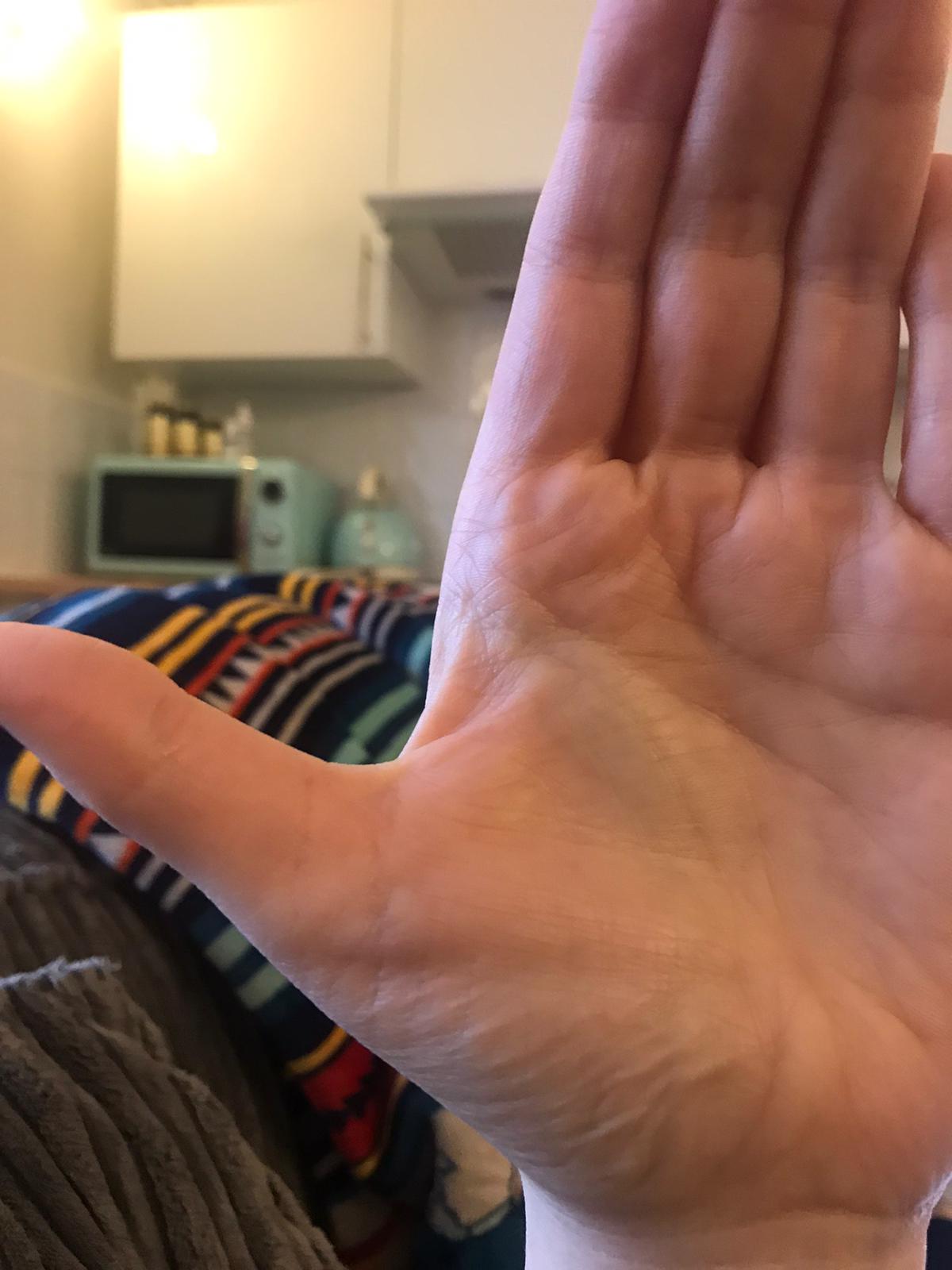 Hand and arm weakness, weak grip, muscle atrophy in legs