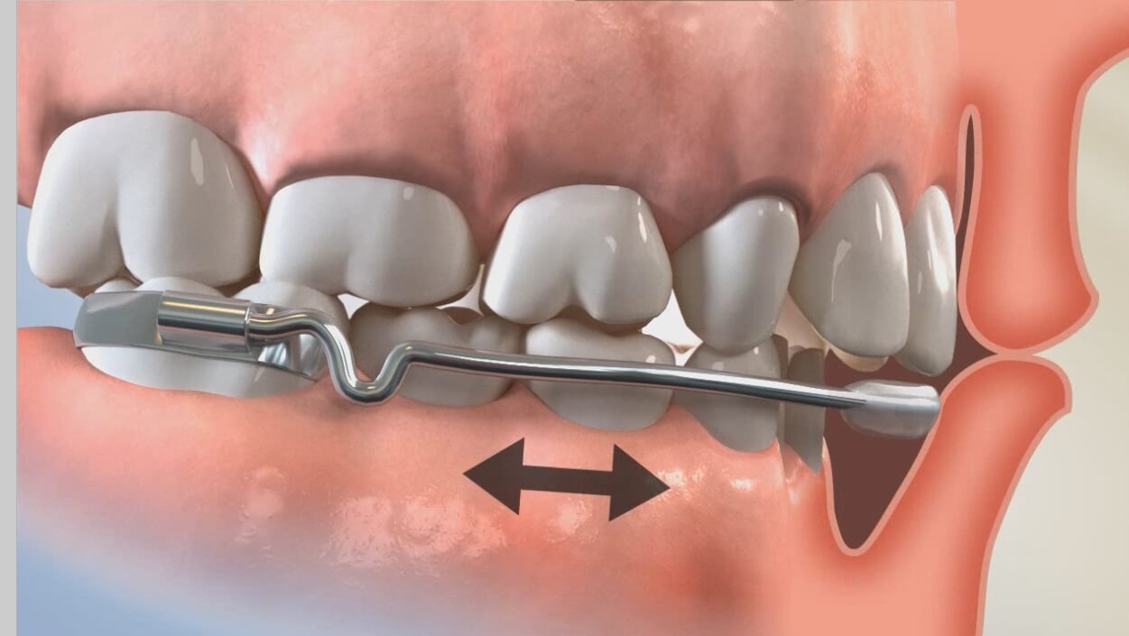 Orthodontic Appliances Altera Orthodontics