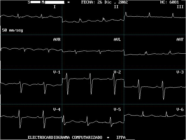 High Altitude Pulmonary Edema Medical Case Discussion IPPA